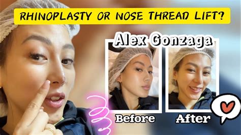 Alex Gonzaga S Nose Thread Lift With Doc Carlo Youtube