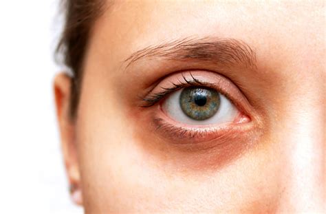 Dark Circles Under The Eyes Causes And Solutions Iris