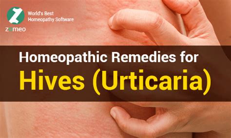Homeopathic Remedies For Hives Urticaria Hompath