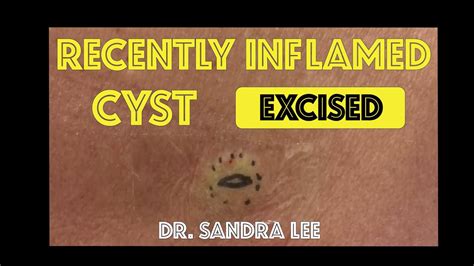 Recently Inflamed Cyst On The Back Excised Youtube