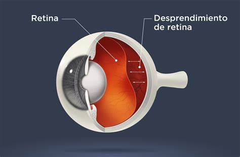Descolamento da retina: sintomas, causas e tratamento | All About Vision