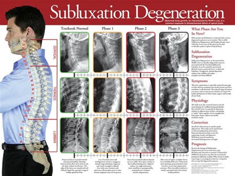 Subluxation Degeneration Wall Chart Clinical Charts And Supplies