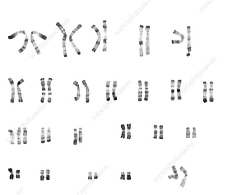 Trisomy 13 Karyotype Female Stock Image C0030983 Science Photo Library