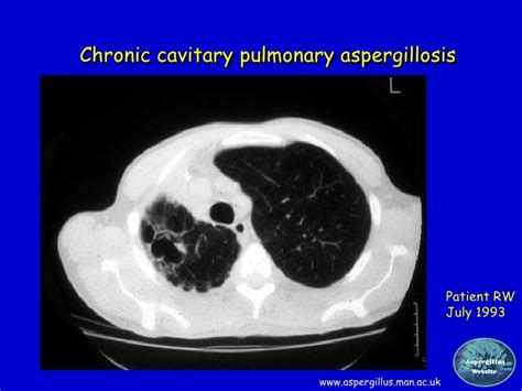 Powerpoint On Aspergillosis