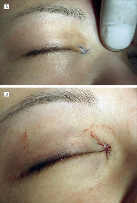 Modified Y V Epicanthoplasty With Raised Medial Canthus In The Asian
