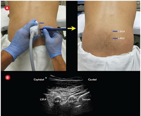 How To Perform An Ultrasound Assisted Lumbar Puncture Acep Now