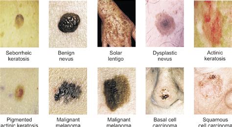 Examples Of Suspicious Skin Lesions The Fi Rst Three Lesions In The