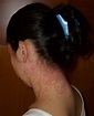 File:Euproctis Chrysorrhoea skin rash.jpg - Wikipedia