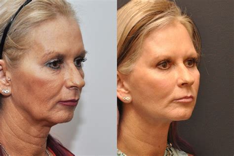 Facial Liposuction Photos Cincinnati Facial Plastic Surgery