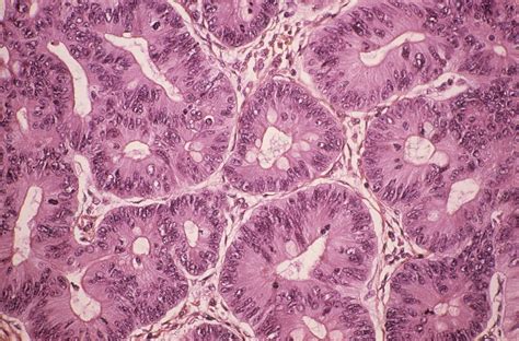 Cancer Intestinal Polyp Light Micrograph Stock Image C0227173