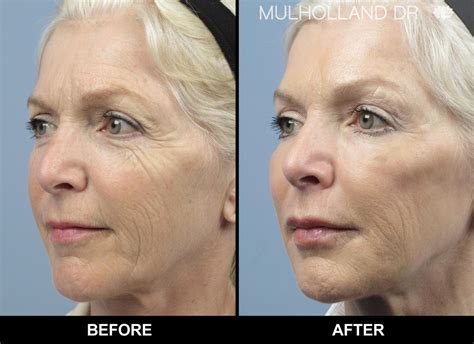 Botox Face Lifting 5 Years Younger In 30 Minutes Spamedica Prlog