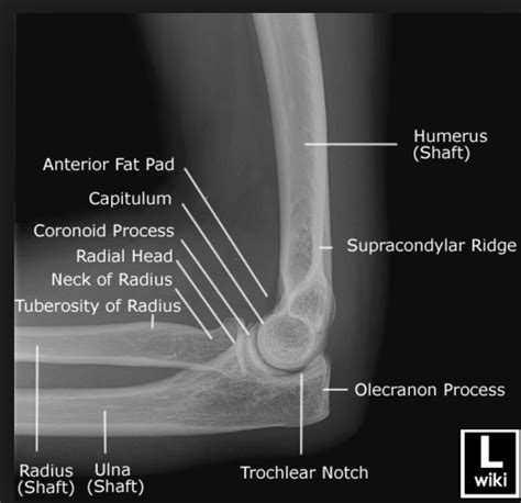 Elbow Dislocation Core Em