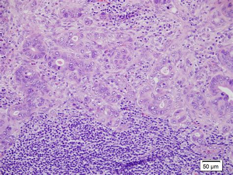 Virchows Node With Adenocarcinoma High Power Picture