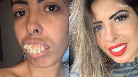 Truth about Jaqueline Alarcãos viral teeth transformation in TikTok