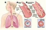 Home Remedies Emphysema Images