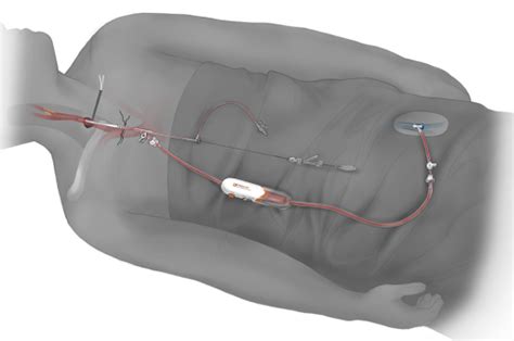 Surgicalcare First To Offer Innovative Procedure For The Treatment Of