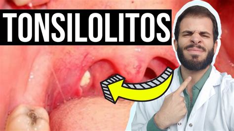 Tonsilolitos👄💀 ¿cómo Eliminar Las Bolitas Blancas De La Garganta Youtube