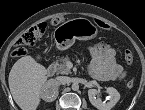 An Aggressive Case Of Adrenocortical Carcinoma Complicated By