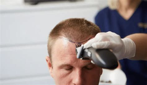 What Is A Hair Transplant Package Turkey Fue Hair Transplant Cost
