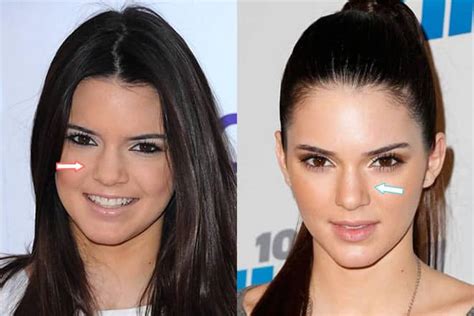 Kendall Jenner Lip Injections And Plastic Surgery