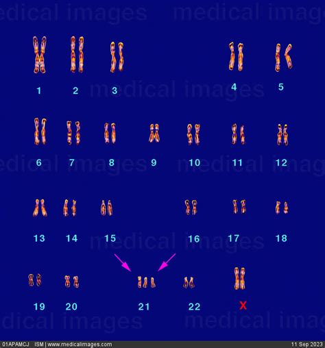 Stock Image Karyotype Of A Female Showing Downs Syndrome Trisomy Of Chromosome 21 C Sovereign