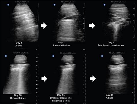 Lung Ultrasound In The Monitoring Of Covid 19 Infection Rcp Journals