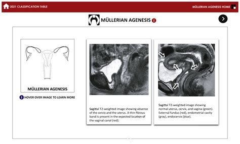 ASRM müllerian anomalies classification Fertility and Sterility