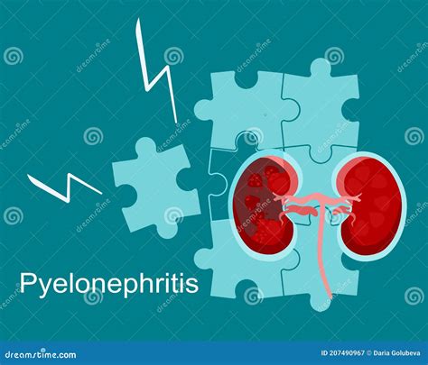 Pyelonephritis Concept Of Cystitis Are Shown Urolithiasis