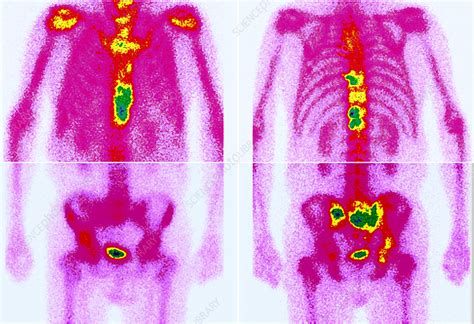 Secondary Bone Cancer Gamma Scans Stock Image M1340692 Science