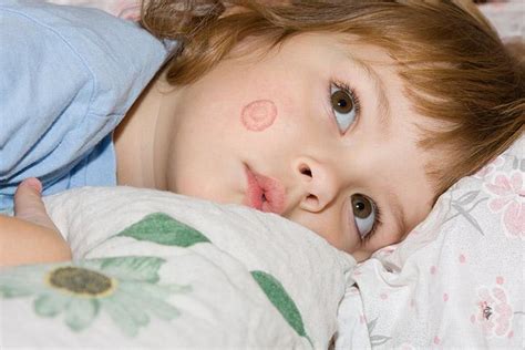 How To Treat Ringworm In Children A Comprehensive Guide 4akid
