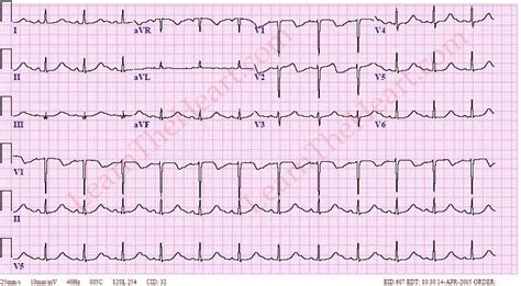 Hypocalcemia Ecg Findings And Examples