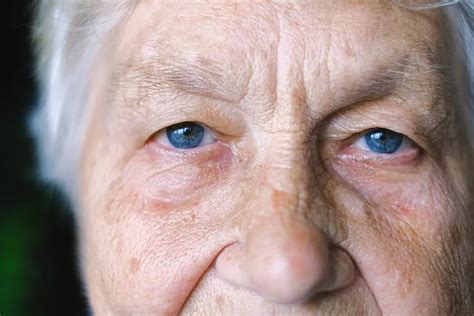Age Spots Liver Spots Treatment Ca Dermatology Institute