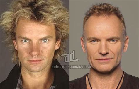 Unveiling The Mystery Did Sting Undergo Rhinoplasty Justinboey