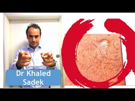 Large Cyst Removal Dr Khaled Sadek London Cyst Clinic YouTube