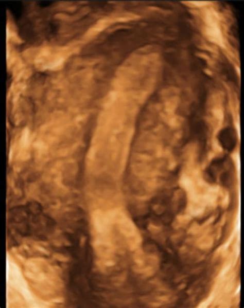 Unicornuate Uterus Ultrasound Images E Start