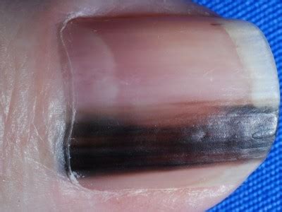 ■爪カンジダ症 症状としては爪白癬とほぼ同じ。 診断は培養でカンジタを検出すること。 治療は抗真菌薬の内服。 爪カンジダ 縦の線が入り先端が割れています. すじ 足の爪が黒い 病気 画像 - Hello Doctor