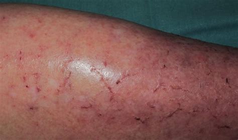 Dermatitis En Las Piernas Por Mala Circulación Cómo Detectarla