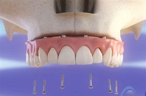 Rehabilitación Del Maxilar Superior Con Implantes Dentales Vídeo 3d