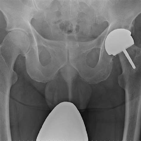 Follow Up Ap Radiograph Of The Pelvis Of The Patient Approximately 36