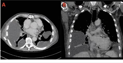 Figure 1 From A Case Report Of An Extremely Rare And Aggressive Tumor