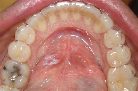What Do The Early Stages Of Mouth Cancer Look Like In Hindi Jima