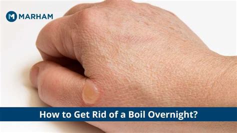 How To Get Rid Of A Boil Overnight Home Remedies To Treat Boil Marham