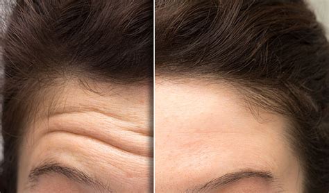 Forehead Lines Treatment And Shaping Melbourne Treatment Areas Face