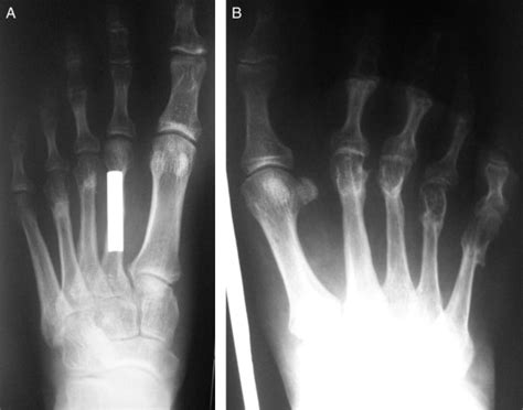 Surgical Correction Of Metatarsal Malunion The Journal Of Foot And