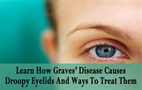 Learn How Graves Disease Causes Droopy Eyelids And Ways To Treat Them