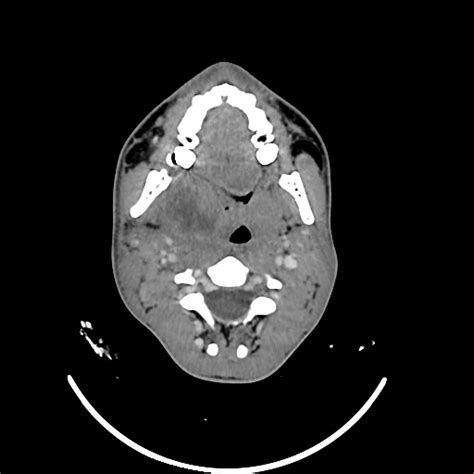 Peritonsillar Abscess Image