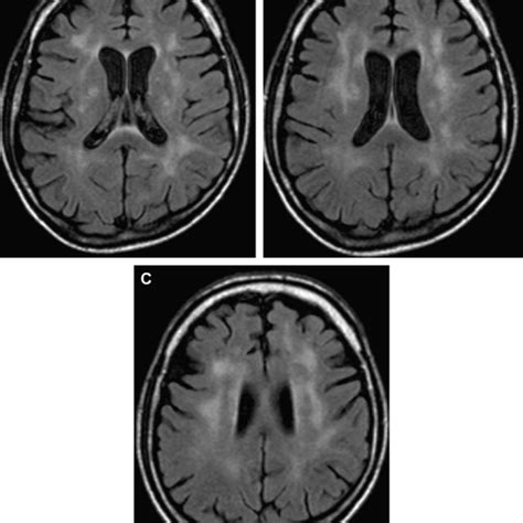 Cerebral Toxoplasmosis Responding To Therapy A Axial T2 Weighted