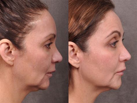 Laser Facelift Profound Microlift Before And Afters Beverly Hills