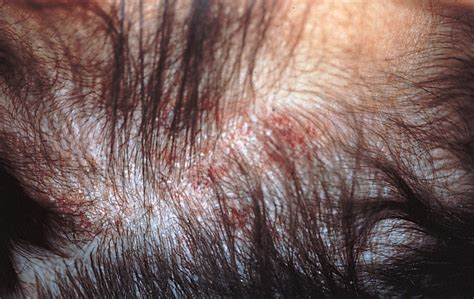 Bullous And Hemorrhagic Lesions Jama Dermatology The Jama Network