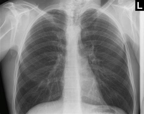 Normal Child Chest X Ray Image Kidkads